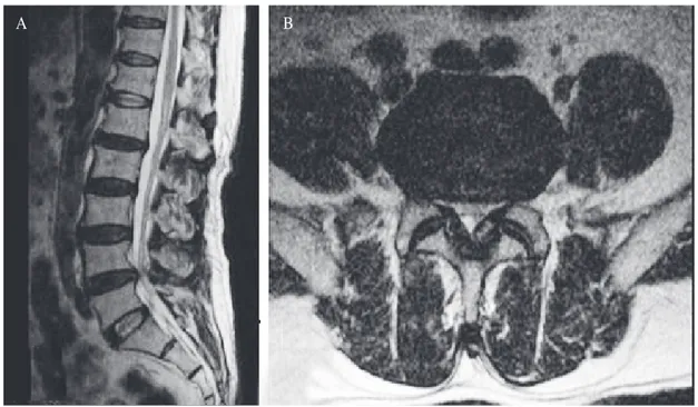 Fig. 1. Magnetic resonance images from the private hospital does not reveal stenotic lesion which can cause cauda  equine syndrome