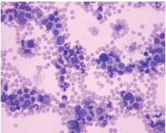 Fig. 1. PB smear shows that myeloid cells are  markedly increased and various stages of maturation  form.