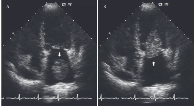 Fig. 2. (A) Abdominal computed tomographic image shows the upper tip of a large embolus (arrow) in the  abdominal aorta and infarctions of both the kidneys