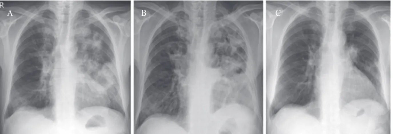 Fig. 1. (A) Initial chest radiography shows multifocal consolidation and cavities in both lungs