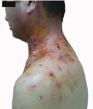 Fig. 2. Superfical cervical plexus block was done at  left C4 level. The arrowheads points needles which  located behind sternocleidomastoid (SCM) muscle  and did not penetrate deep fascia
