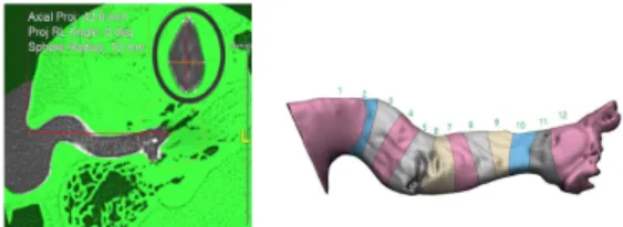 Fig.  2.  External  ear  canal  segmentation  of  DICOM  image  and  cross-section  by  phase 