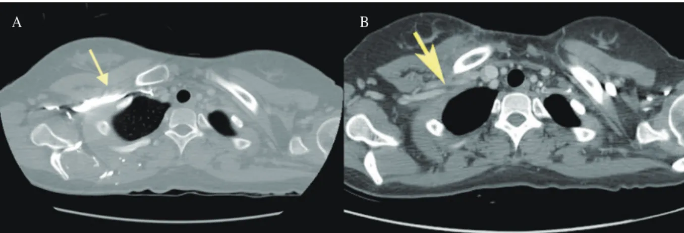 Fig. 1. (A) Preoperative chest computed tomography (CT) scan reveals compression of the right subclavian artery  and vein between the clavicle and first rib (arrow)