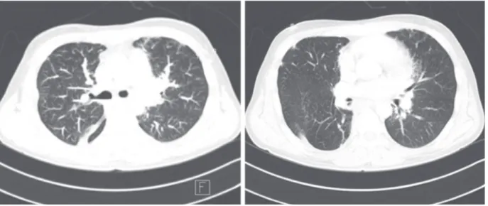 Fig. 2. Computed tomography (CT) findings showing dilatation of pulmonary arteries, especially peripheral  branches in both lungs and no bronchiectatic change.