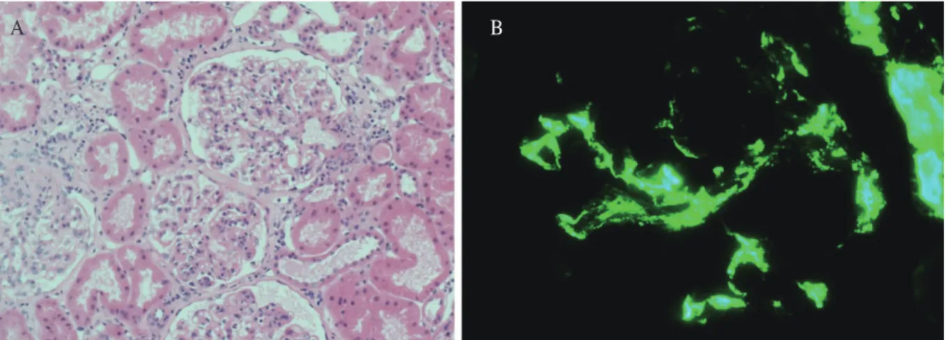 Fig. 1. (A) Light microscopic finding in kidney biopsy shows mild to moderate increase of mesangial cells and  matrix (H&amp;E stain, × 200)