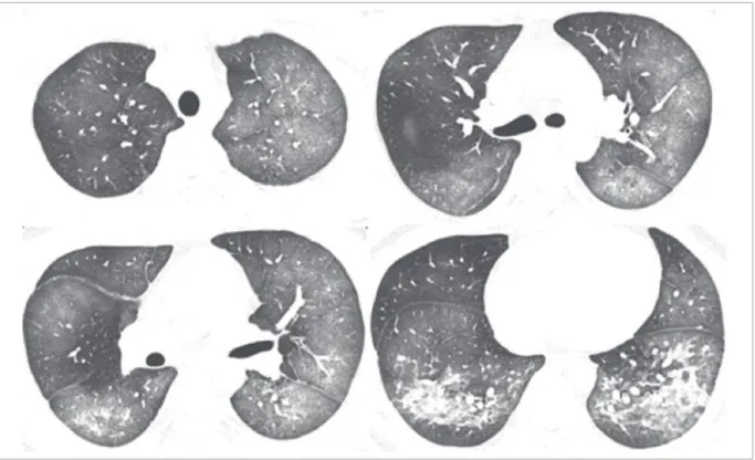 Fig. 2. High resolution computed tomography scans show diffuse bilateral ground-glass opacities and areas of  consolidation in both lower lung fields.