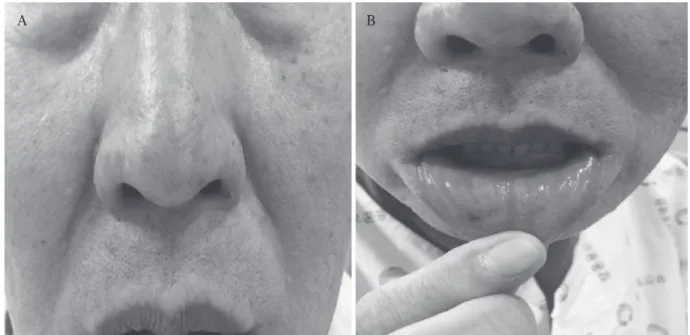 Fig. 1. Mucocutaneous telangiectasia on nose (A) and lip (B).