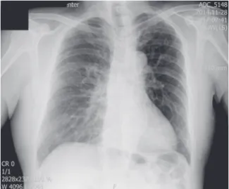 Fig. 1. Chest X-ray shows no active tuberculosis  lesion in the lungs.