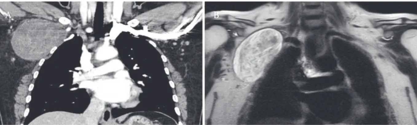 Fig. 1. (A) Chest computed tomography reveals a homogeneous mass, measuring 10 × 6 × 7 cm, located around  the right brachial plexus area