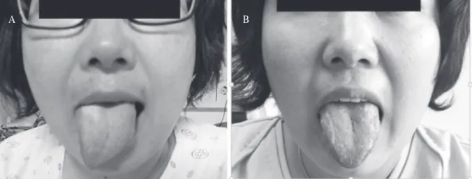 Fig. 1. (A) The figure shows tongue deviation to the right side when protruded at admission