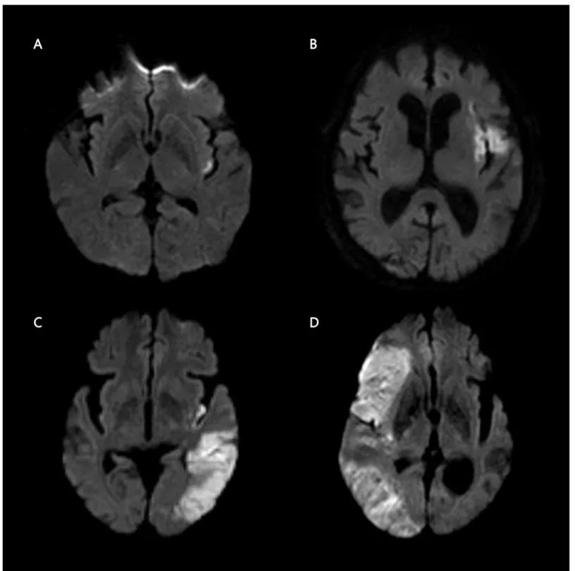 Fig 1. Patterns of insular involvement in ischemic stroke. High signal intensity on diffusion-weighted images illustrates the patterns of insular involvement: isolated insula (A), insula plus adjacent region (B), insula plus remote region (C), and large te