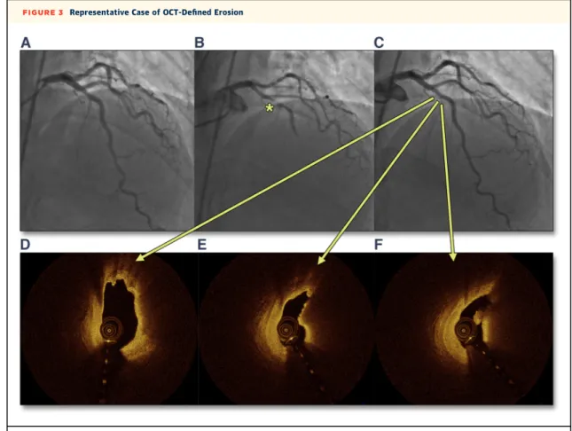 FIGURE 3 Representative Case of OCT-Deﬁned Erosion