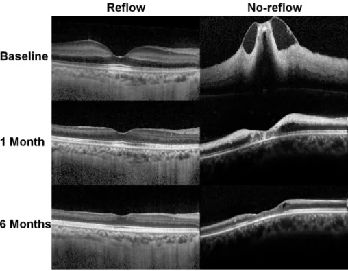 Fig 3 shows the baseline, 1-month, and final BCVA in the no-reflow and reflow eyes. There were significant differences in all BCVA values between groups, indicating a significantly poor