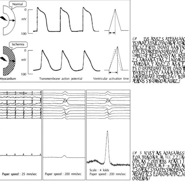 Fig. 1. The scheme of upper pa- pa-nel shows normal pattern of  tra-nsmembrane action potential  and ventricular activation time  (VAT)
