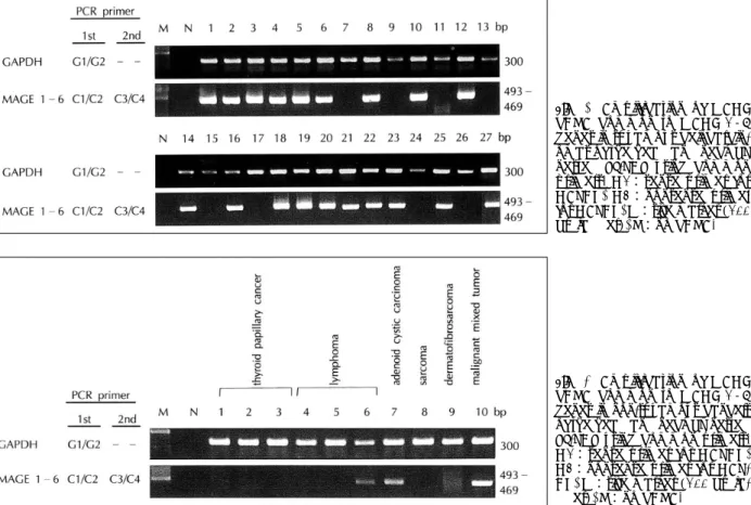 Fig. 2. Amplification of MAGE  cDNA common to MAGE 1-6  genes in squamous cell  carcin-omas of the head and neck by  nested RT-PCR using common  primers