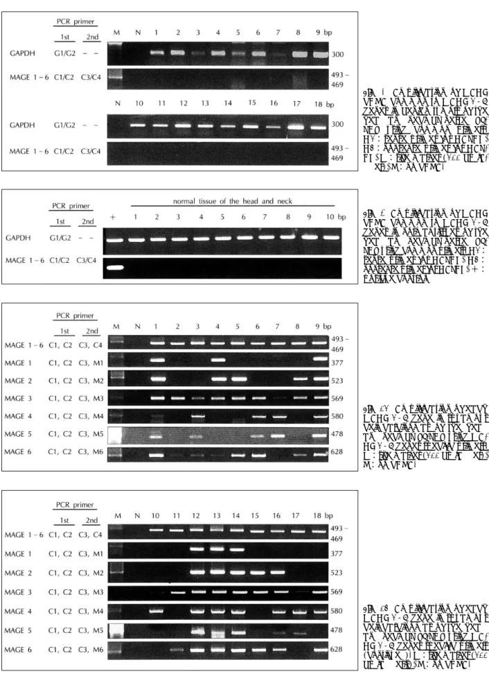 Fig. 4. Amplification of MAGE cDNA common to MAGE 1-6 genes in benign tumors of the head and neck by nested  RT-PCR using common primers.