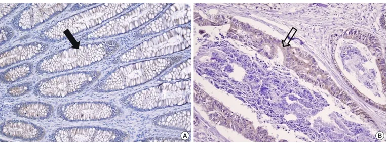 Fig. 1. Sections of normal colonic mucosal (A) and cancer (B) tissue immunostained for leptin (×200)