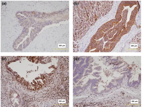 Fig. 3. (a) Loss of E-cadherin expression in PanIN-3 lesions associated with chronic pancreatitis (CP)