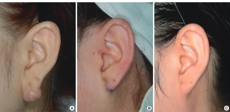 Fig. 2. A case of keloid with radiotherapy