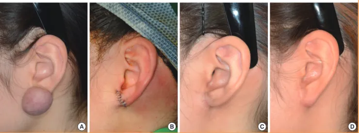 Fig. 3. A case of keloidectomy with radiotherapy