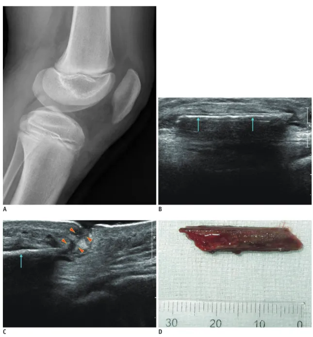 Fig. 1. Case of retained foreign body in 10-year-old male with complaint of knee pain after soccer