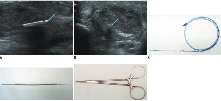 Fig. 3. Case of retained foreign body in 54-year-old male who complained of painful foot swelling for duration of 4 months