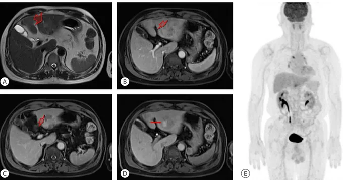 Figure 1. Abdominal CT scan. About 3.0 cm sized rim-enhanced hepatic mass was shown at S2-3 in arterial phase (A, arrow) and non-visible in  delayed phase (B)