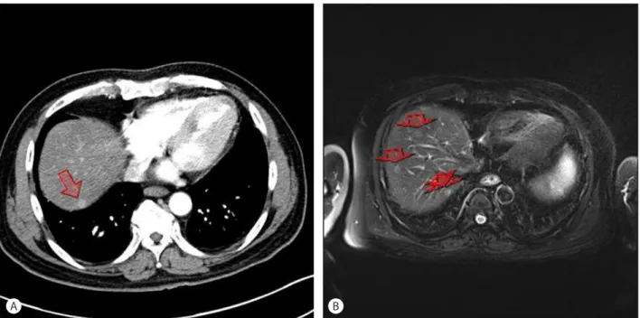 Figure 5. Newly developed arterial enhancing nodule on abdominal CT scan (A, arrow) and multiple recurred nodules on liver primovist MRI (B,  arrows)