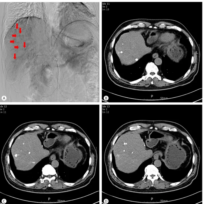 Figure 6. Hepatic angiography shows multiple tumor staining (A, arrows). After TACE, compact lipiodol uptake was shown on follow up non- non-enhancing CT scan (B, C, D)