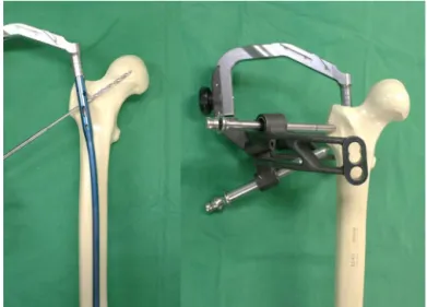 Fig. 3. After 2 years of operation, removal of implant was done.
