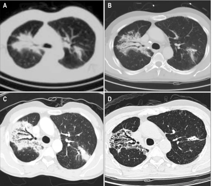 Fig. 2. The initial evaluation showed consolidative lesions with patchy ground-glass opacities and calcifications (B)