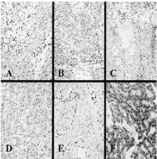 Fig. 5. Immunohistochemistry for (A) p16 (>50%), (B) p18 (>50%), (C) cyclin D1 (<5%), (D) CDK4 (>50%), (E) p53 (5- 50%), and (F) pRb (5- 50%)