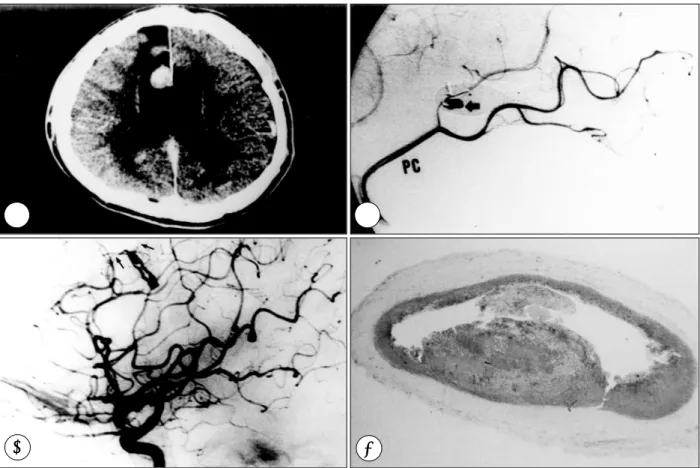Fig. 2. A：Brain computed tomographic(CT) scan with contrast enhancement, axial view, showing a round enhanced mass in  right parafaxial region