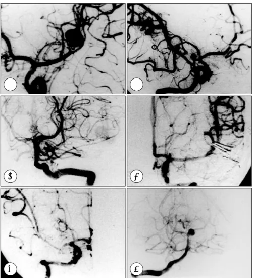 Fig. 4. A &amp; B：Left and right internal carotid angiograms, A-P views, showing large size of aneurysm at peripheral branches of the  left middle cerebral artery(A) and a small size of aneurysm at horizontal portion of the right middle cerebral artery (B)