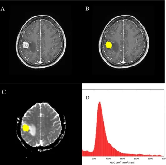 Figure 1.  Processing workflow diagram. (A) contrast-enhanced T1-weighted MR image, (B) contrast-