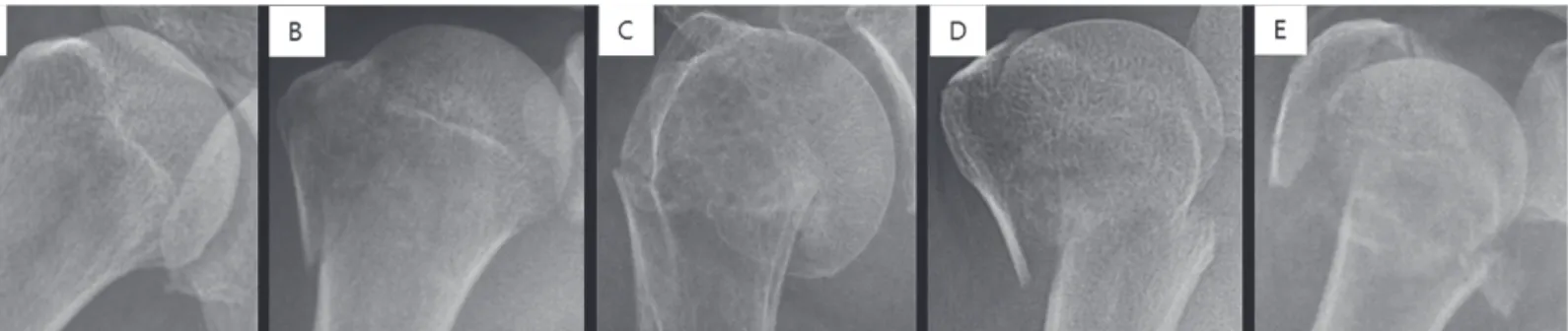 Figure 1. Each shoulder anteroposterior radiograph was manually cropped into a square in which the humeral head and neck are centered such  that they comprise approximately 50% of the square image as illustrated above