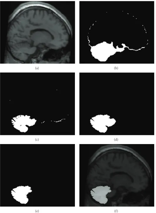 Figure 3: Snapshot of each step in the proposed segmentation procedure. (a) Individual T1 image