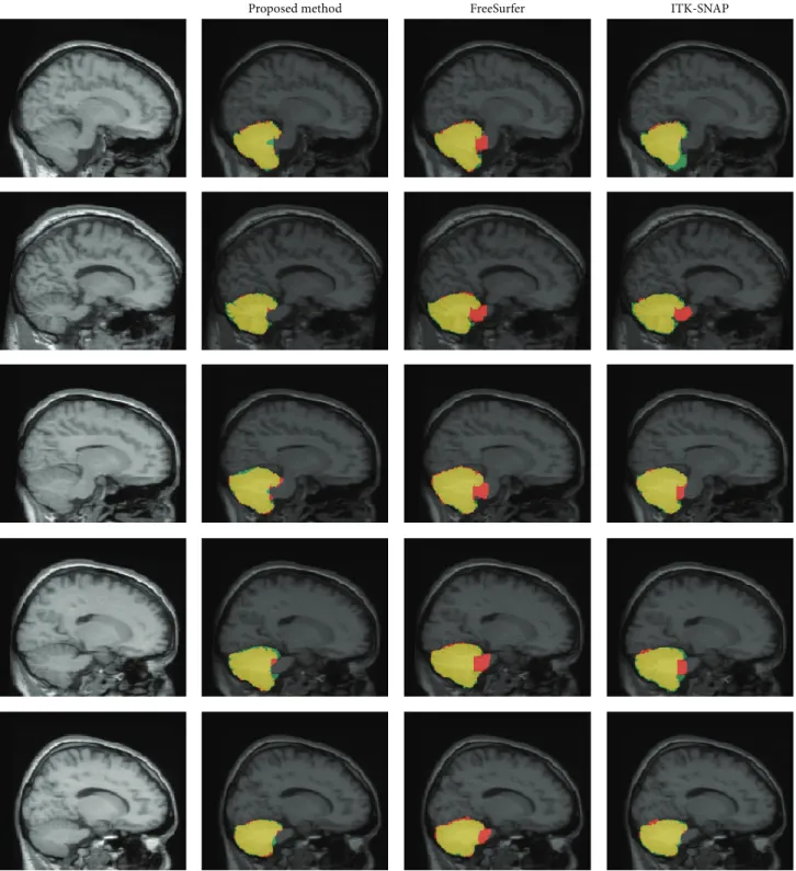 Figure 4: Comparison of each automatic segmentation method and manual definition. Yellow is an identical result; red is overestimation; green is underestimation.