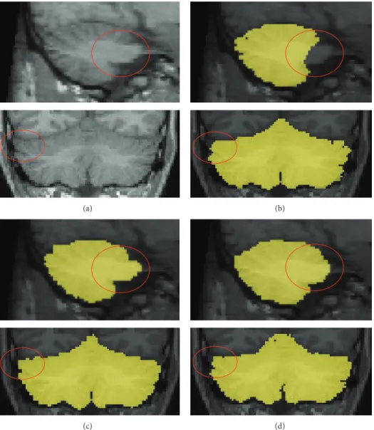 Figure 7: Comparison of the cerebellar segmentation performed with (b) proposed method (c), FreeSurfer, and (d) ITK-SNAP
