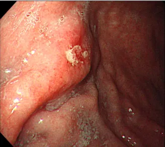 Fig. 2. Endoscopic ultrasonography. It showed about 1.1 cm-sized  homogenous hypoechoic mass in the submucosal layer.