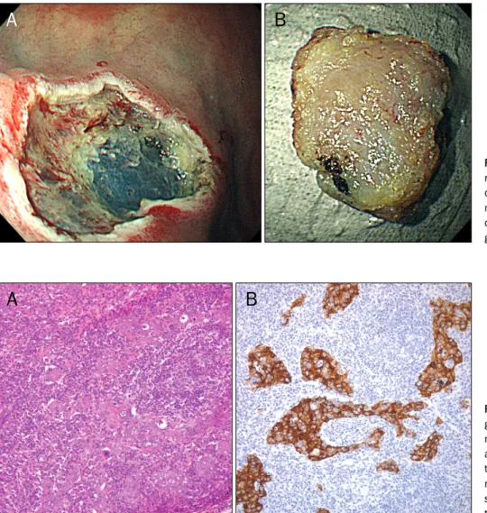 Fig. 3. (A) Endoscopic mucosal  resection (EMR) site. EMR was done to obtain more specimen of submucosal mass