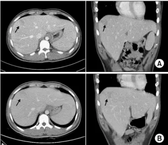 Figure 1. (A) Initial contrast enhanced abdominopelvic com-
