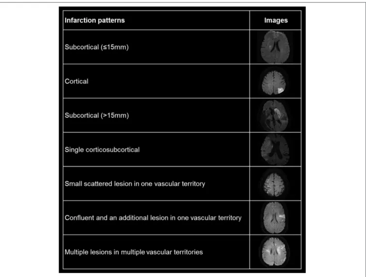 FIGURE 1 | Representative figures for pattern of cerebral infarction in diffusion weighted images.