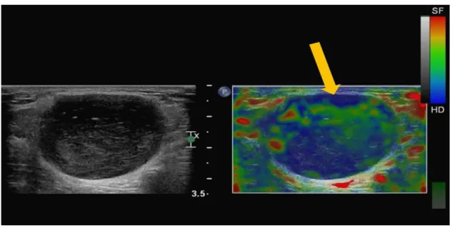 Figure 6. Case of lymphoma: an 83-year-old male presented with a non-tender mass in the left inguinal area