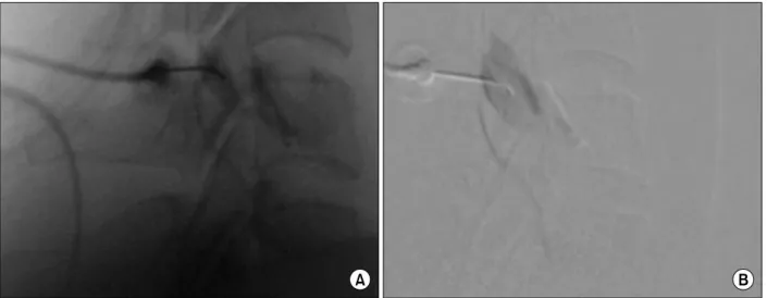 Fig. 1. Comparison of contrast flow with static image and digital subtraction angiography (DSA)