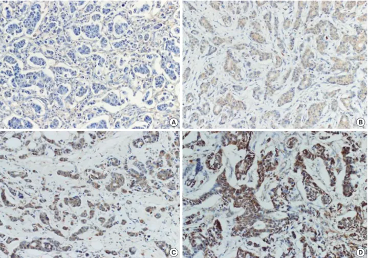 Figure 1.  Representative microphotographs of dual-specificity protein phosphatase 4 (DUSP4) immunostaining in invasive ductal carcinoma (×200)