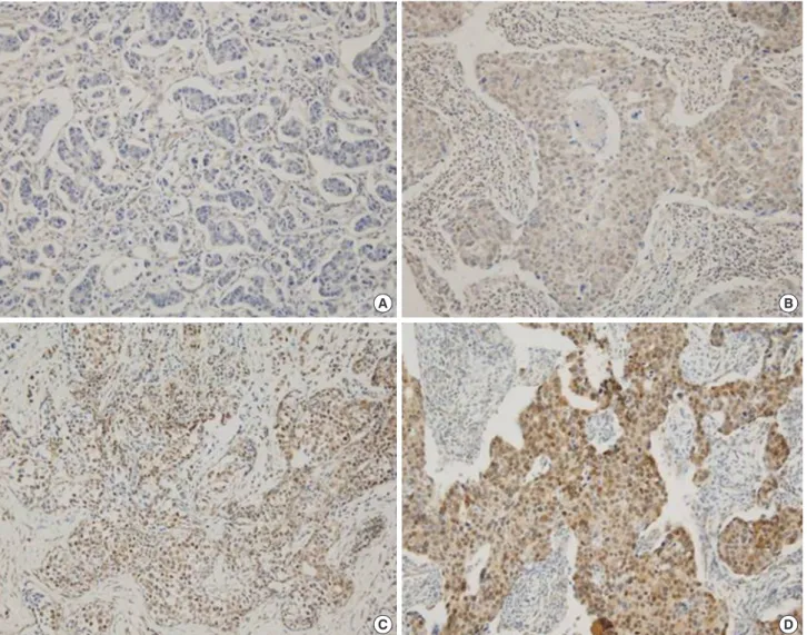 Figure 1.  Representative sections of the immunohistochemistry of SMAD4 in breast cancer tissue (magnification, × 200)