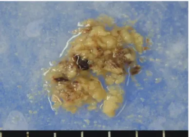 Fig. 4. Photomicrographs of the surgical specimen. A: The result of hematoxylin and eosin staining shows pleomorphism, trabecular pattern 