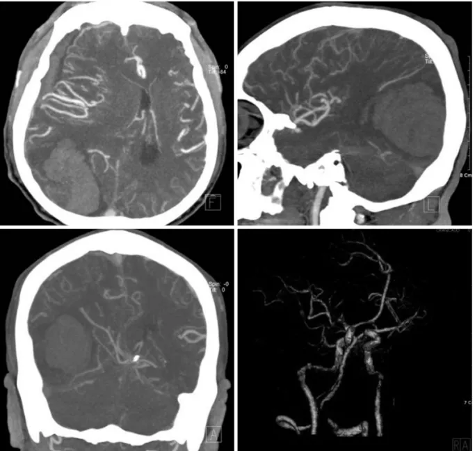 Fig. 2. Brain angiographic computed tomographic scans showing no enhanced lesion or vascular abnormality in the hemorrhagic area.