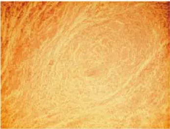 Figure  2.  Laparoscopic  finding.  There  is  a  thick  fibrous  band  bet- bet-ween  visceral  and  parietal  peritoneum.